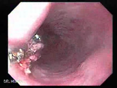 Adenocarcinoma of the Gastroesophageal Junction - Removal of Necrotic Tissue