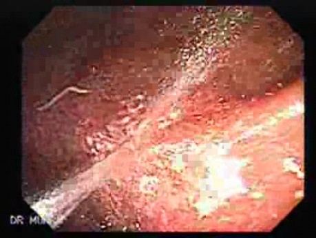 Schistosoma Mansoni (8 of 9)