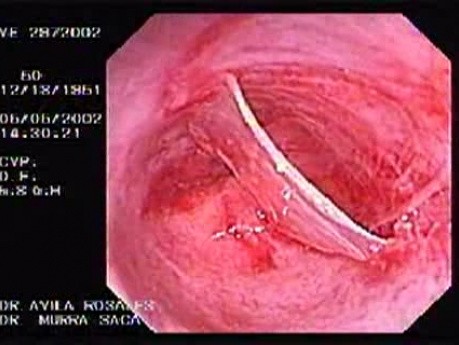 Zollinger- Ellison Syndrome - Gastric Ulcer with Gastrocolic Fistula (10 of 21)