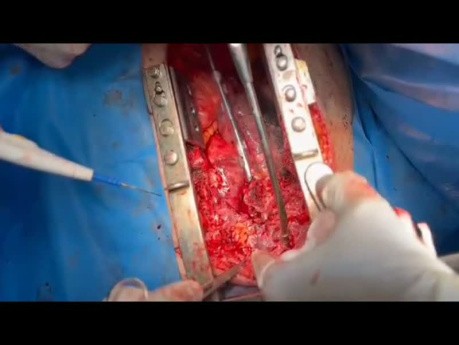 Patient with Post Neck Radiation Innominate Artery Avulsion Undergone Emergency Basis Surgery 