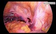 TLH + Sacrocolpopexy Skin to Skin Surgical Video
