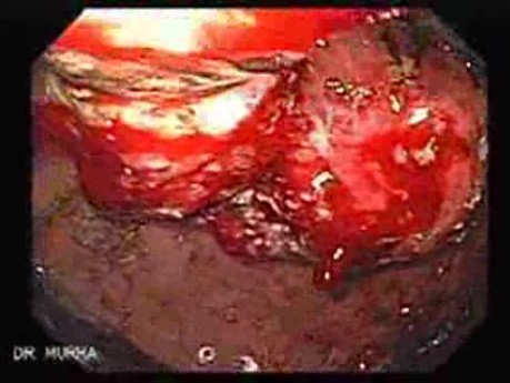 Adenocarcinoma of the Antrum (3 of 5)
