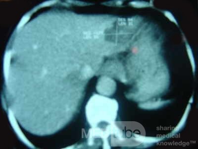 ScirrhousGastric Carcinoma (Linitis Plastica) (12 of 15)