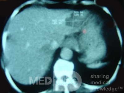 ScirrhousGastric Carcinoma (Linitis Plastica) (12 of 15)