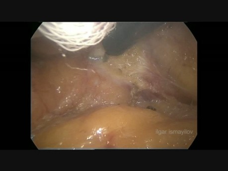 Laparoscopic Left Adrenalectomy