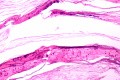 Histology of Tympanic Membrane Cast
