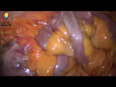 Searching for Mickel's Diverticulitis