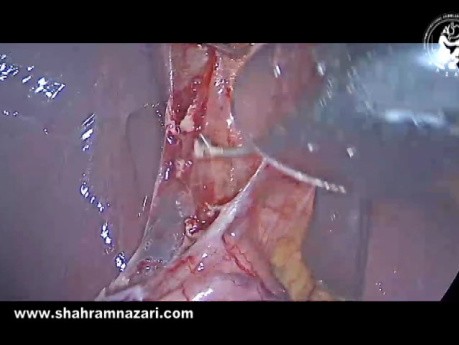 The Anatomy of Rouviere's Sulcus as Seen During Laparoscopic Cholecystectomy
