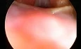 Acute subepithelial haemorrhage