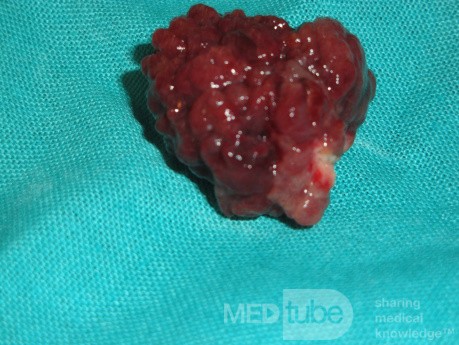 Giant Multilobulated Gastric Polyp (20 of 20)