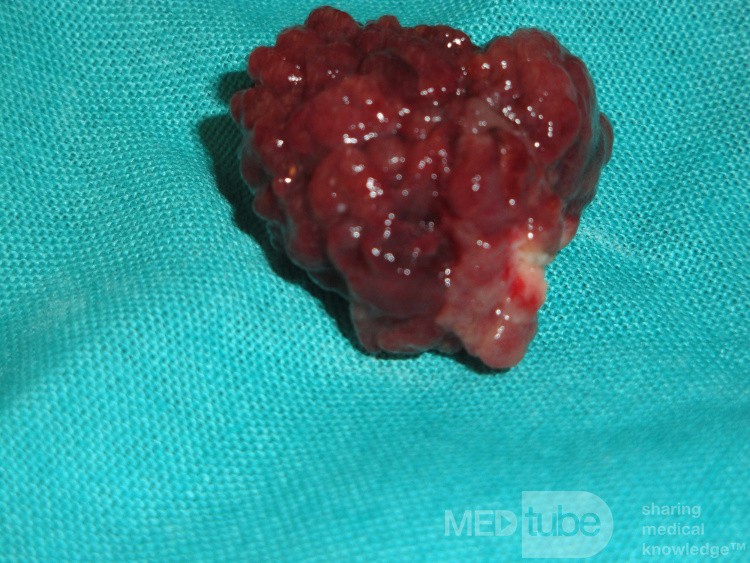 Giant Multilobulated Gastric Polyp (20 of 20)