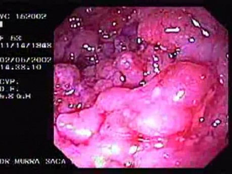 Severe Case Of Ulcerative Colitis (6 of 6)