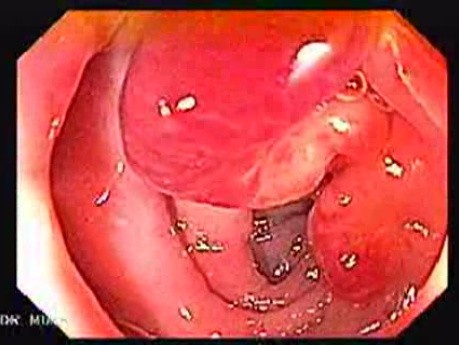 Endoscopic View Of Diverticulitis Of The Sigmoid (1 of 4)