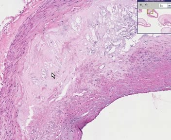 Coronary Arteries - Atherosclerosis