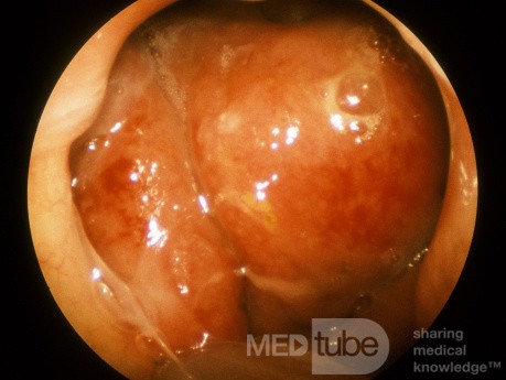 Carcinoma Of The Nasopharynx