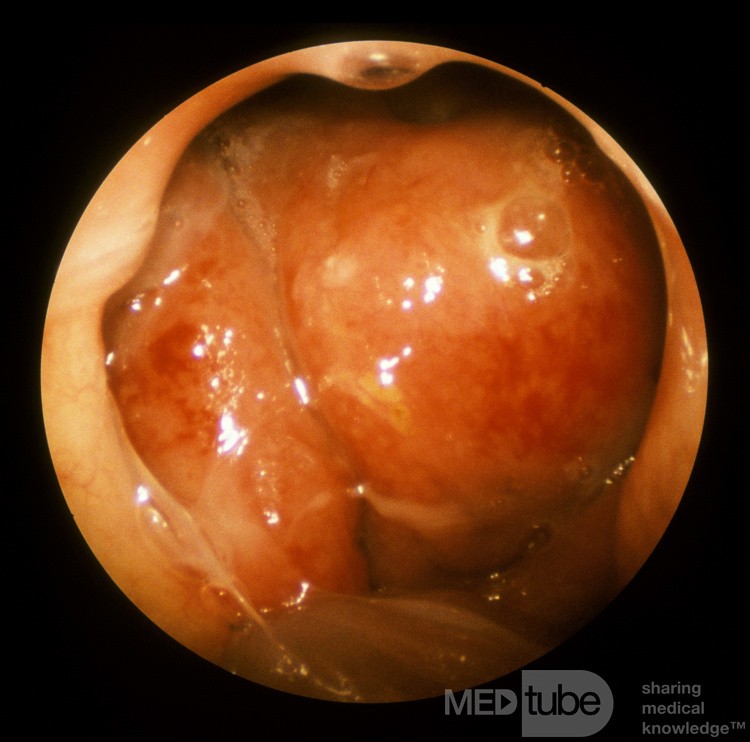 Carcinoma Of The Nasopharynx