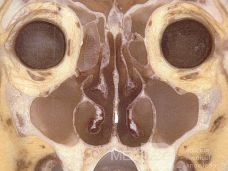 Max Sinus Ostea