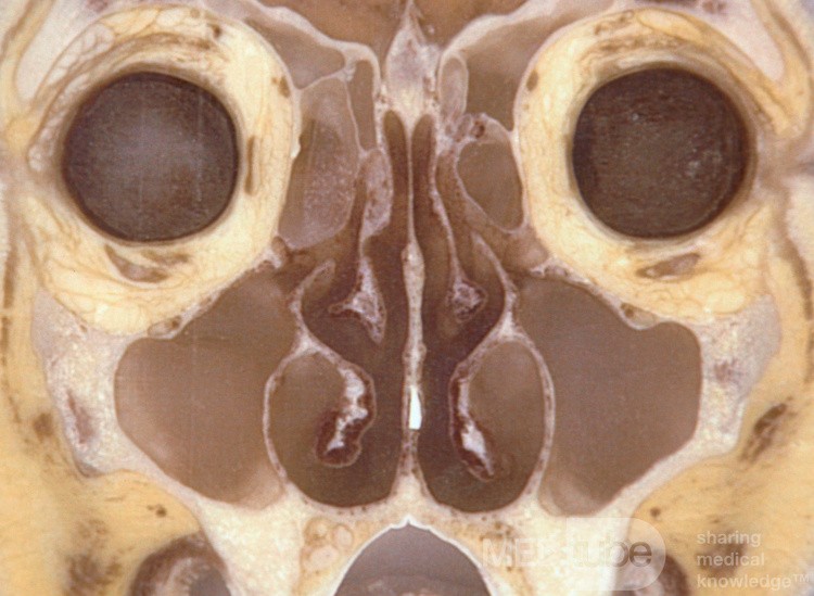 Max Sinus Ostea