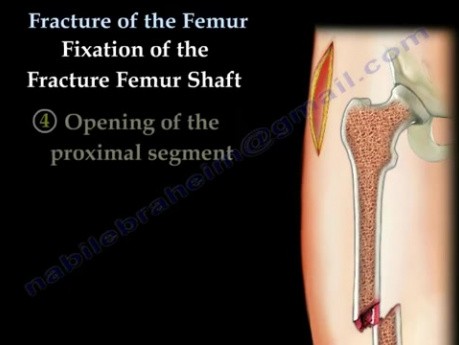 Fracture Of The Femur 