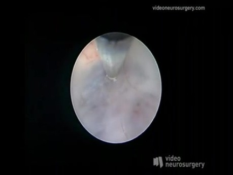 Endoscopic 3Rd Ventriculostomy Surgery - Right Precoronary Approach