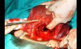 Technique B-Lynch suture for Hemorragia Postparto