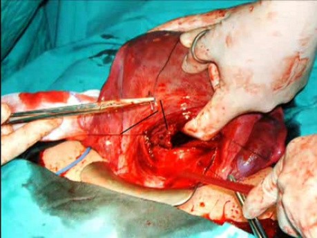 Technique B-Lynch suture for Hemorragia Postparto