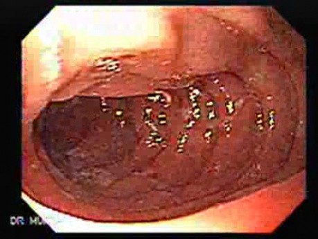 Multiple Duodenal Erosions due to Salmonella Enteritis (4 of 5)