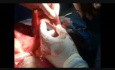 Cystoprostatectomy with Lymphadenectomy and Bricker 