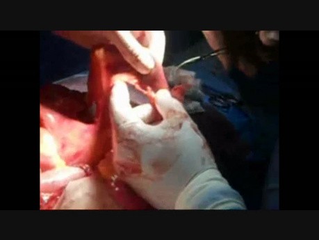 Cystoprostatectomy with Lymphadenectomy and Bricker 