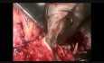 Mitral Valve Replacement  How to Handle the Big MAC