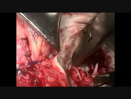 Mitral Valve Replacement  How to Handle the Big MAC