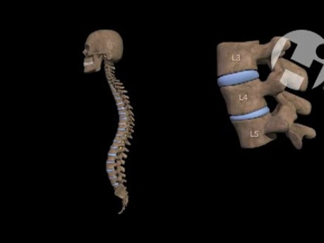 Mechanism of L4 Burst Fracture