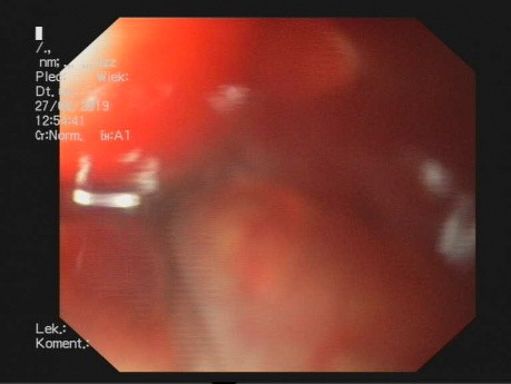 Gastroscopy in a Patient with Boerhaave Syndrome