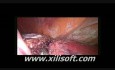 Laparoscopic Left Lobectomy