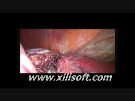 Laparoscopic Left Lobectomy