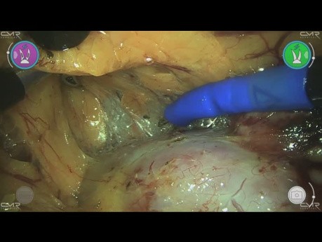 Retroperitoneal Partial Nephrectomy with Versius - Muddassar Hussain