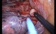 Uniportal VATS Azygos Lobe Dissection 