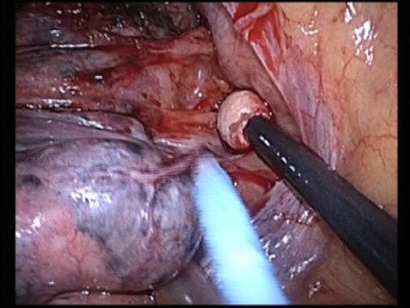 Uniportal VATS Azygos Lobe Dissection 