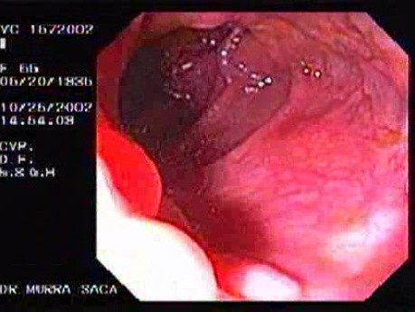 Adenocarcinoma of the Transverse Colon (2 of 2)