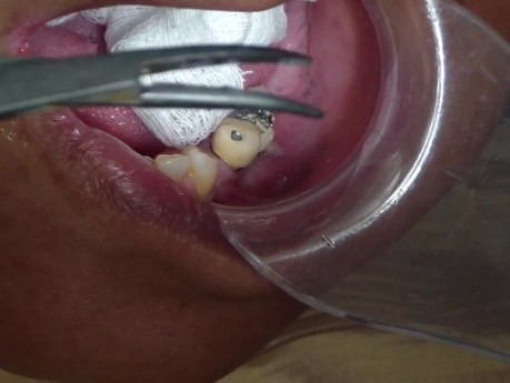 Dental Crown Removal - 