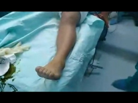 Flatfoot Reconstruction Using Smart Glasses