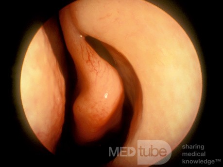 Paradoxically Curved Middle Turbinate [left]
