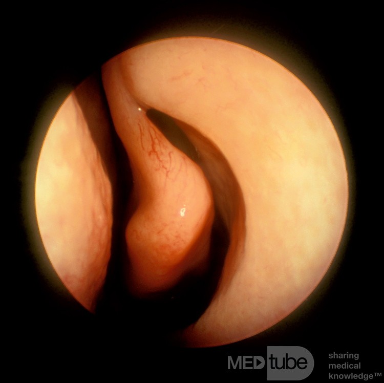 Paradoxically Curved Middle Turbinate [left]