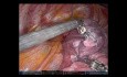 Left Upper Lobe Pulmonary S1-3 Tri-Segmentectomy