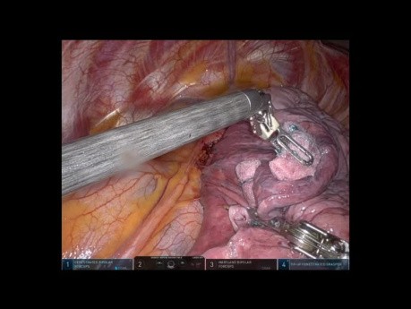 Left Upper Lobe Pulmonary S1-3 Tri-Segmentectomy