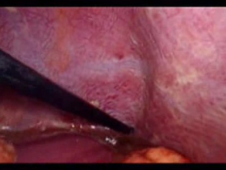 Colonic Perforation With Peritonitis - Laparoscopy (36 of 46)