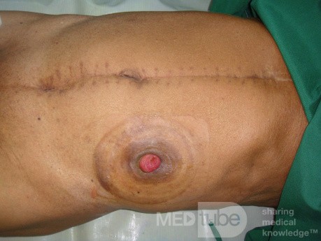 Colostomy