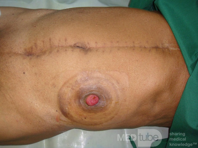Colostomy