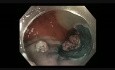 Colonoscopy - Rectal LST G Tumor - EMR