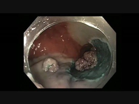 Colonoscopy - Rectal LST G Tumor - EMR